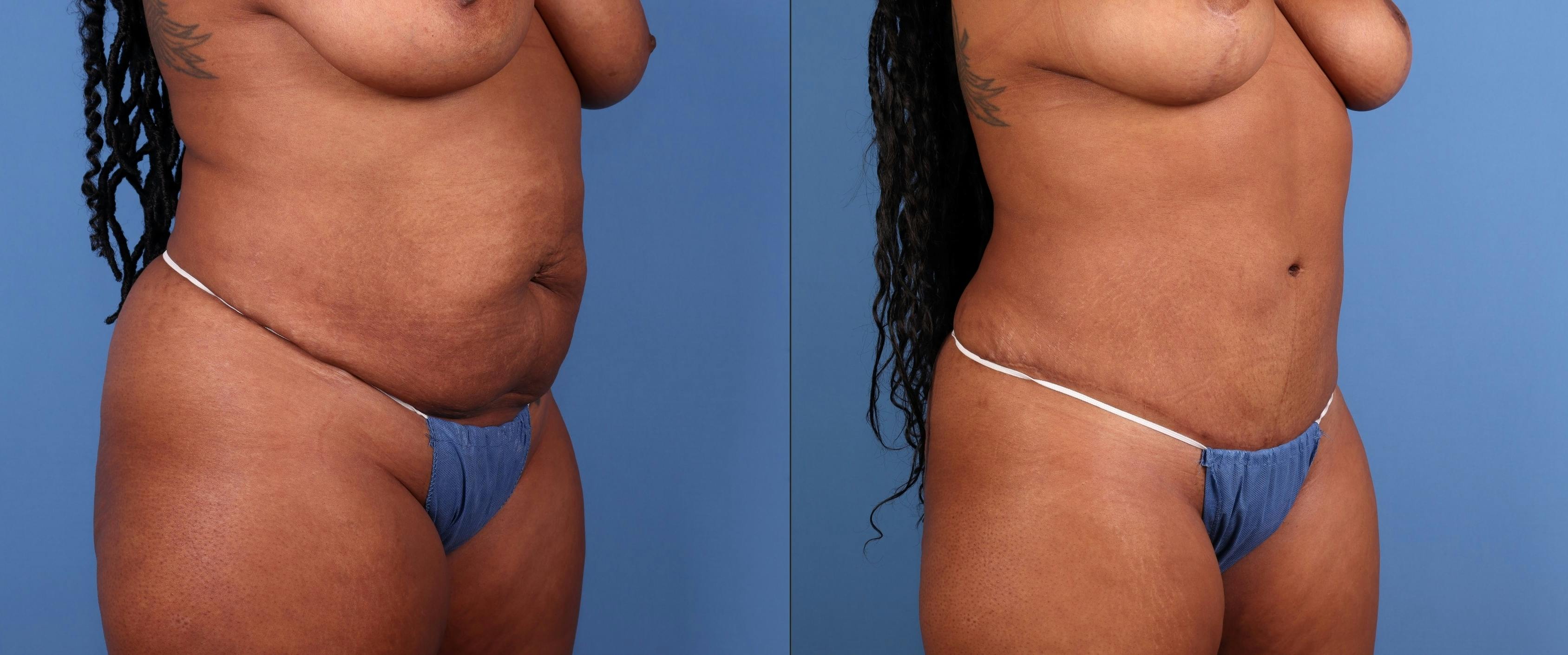 Tummy Tuck Before & After Gallery - Patient 378557 - Image 3