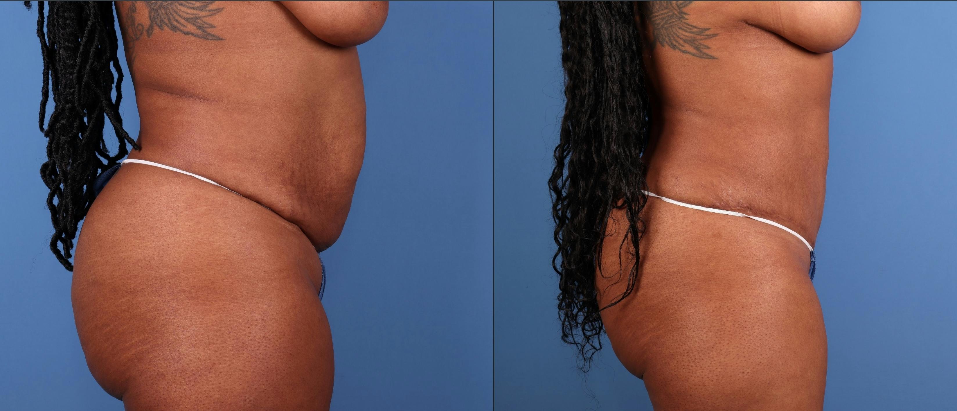 Tummy Tuck Before & After Gallery - Patient 378557 - Image 4