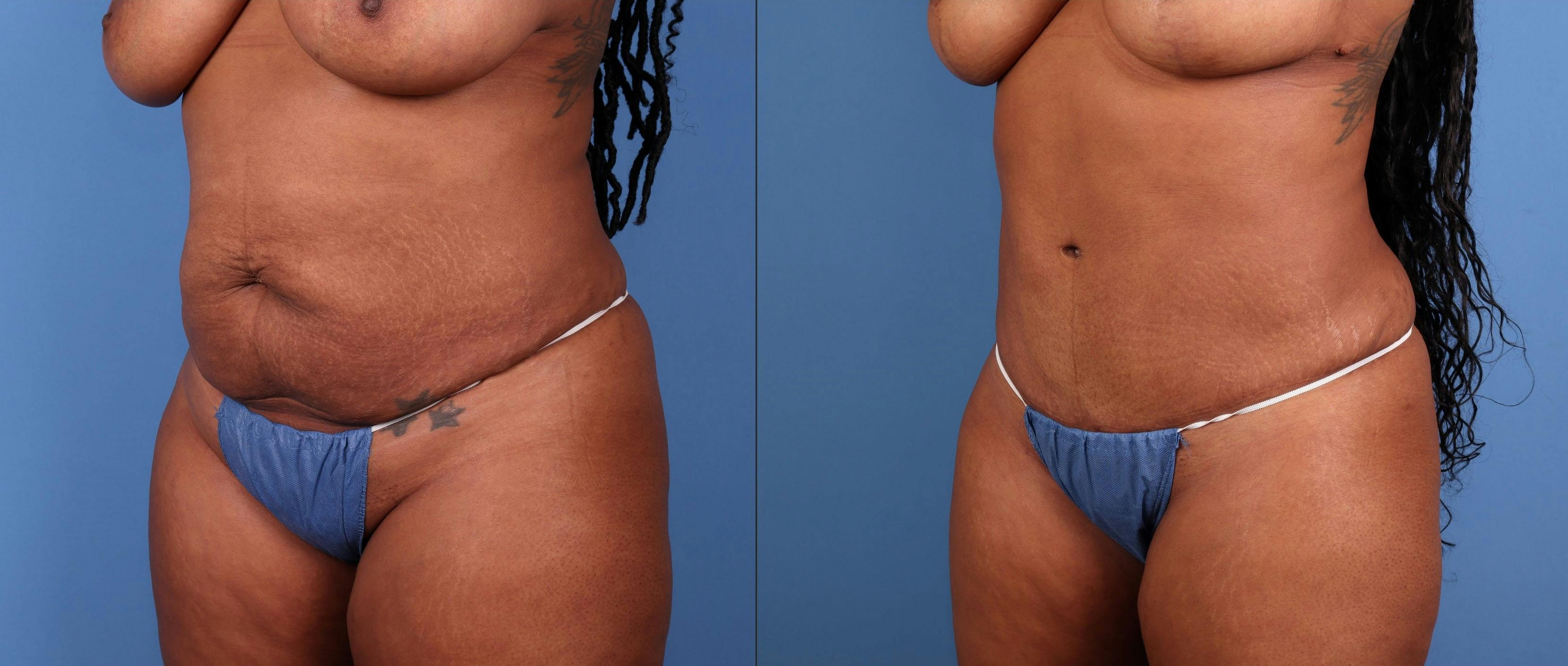 Tummy Tuck Before & After Gallery - Patient 378557 - Image 2