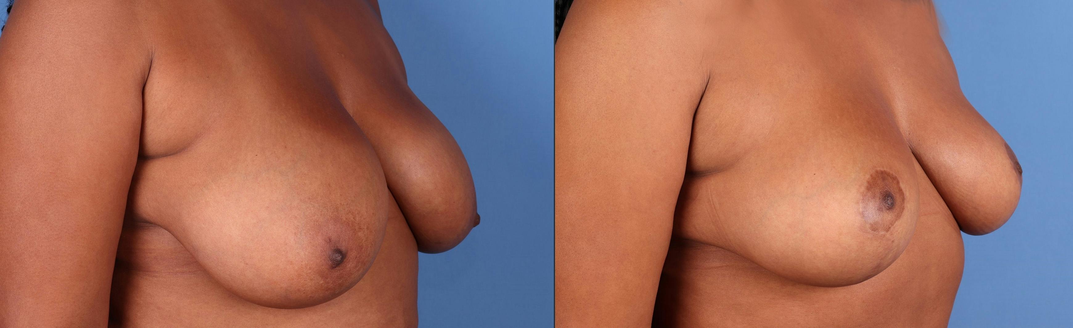 Breast Reduction Before & After Gallery - Patient 376565 - Image 2