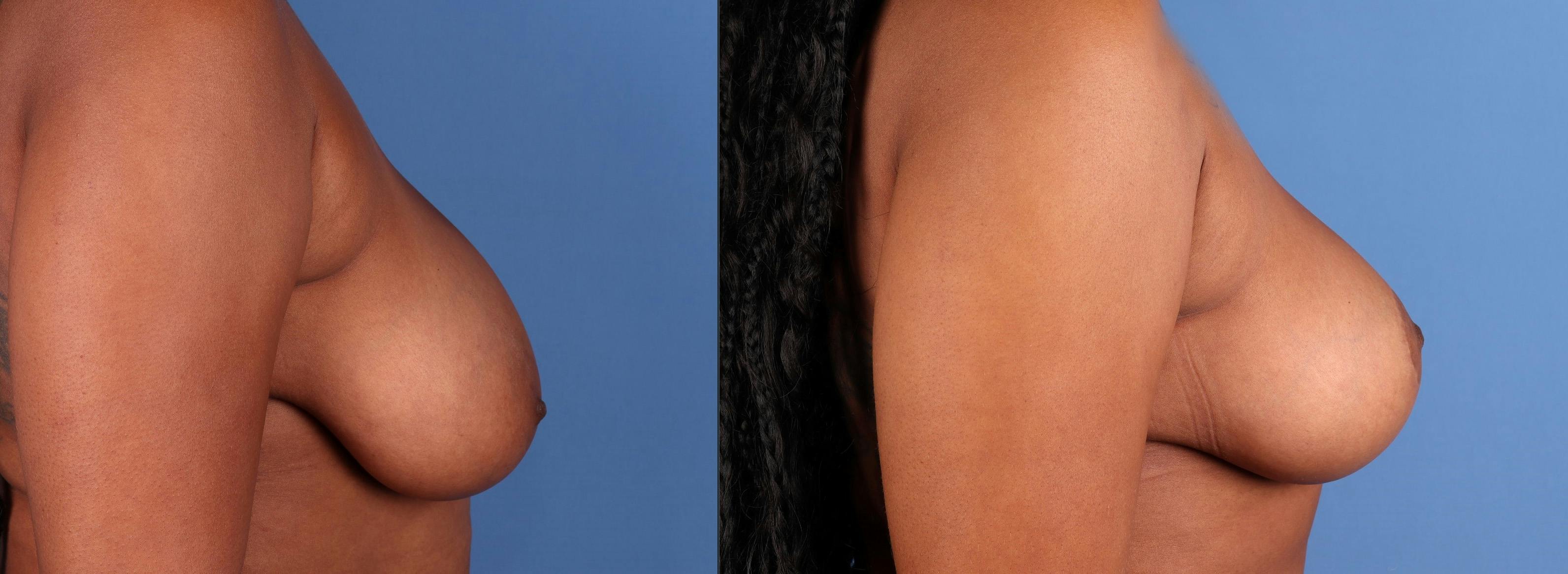 Breast Reduction Before & After Gallery - Patient 376565 - Image 3