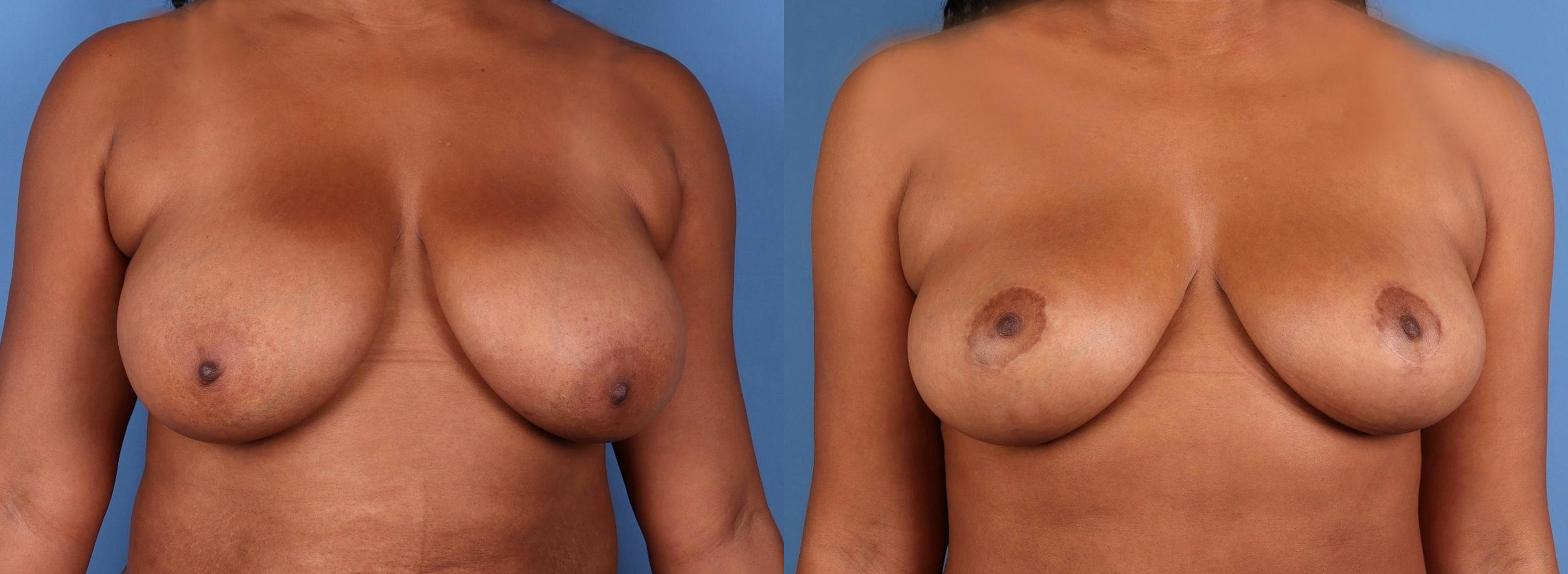 Breast Reduction Before & After Gallery - Patient 376565 - Image 1
