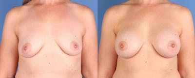 Breast Augmentation Before & After Gallery - Patient 163826 - Image 1