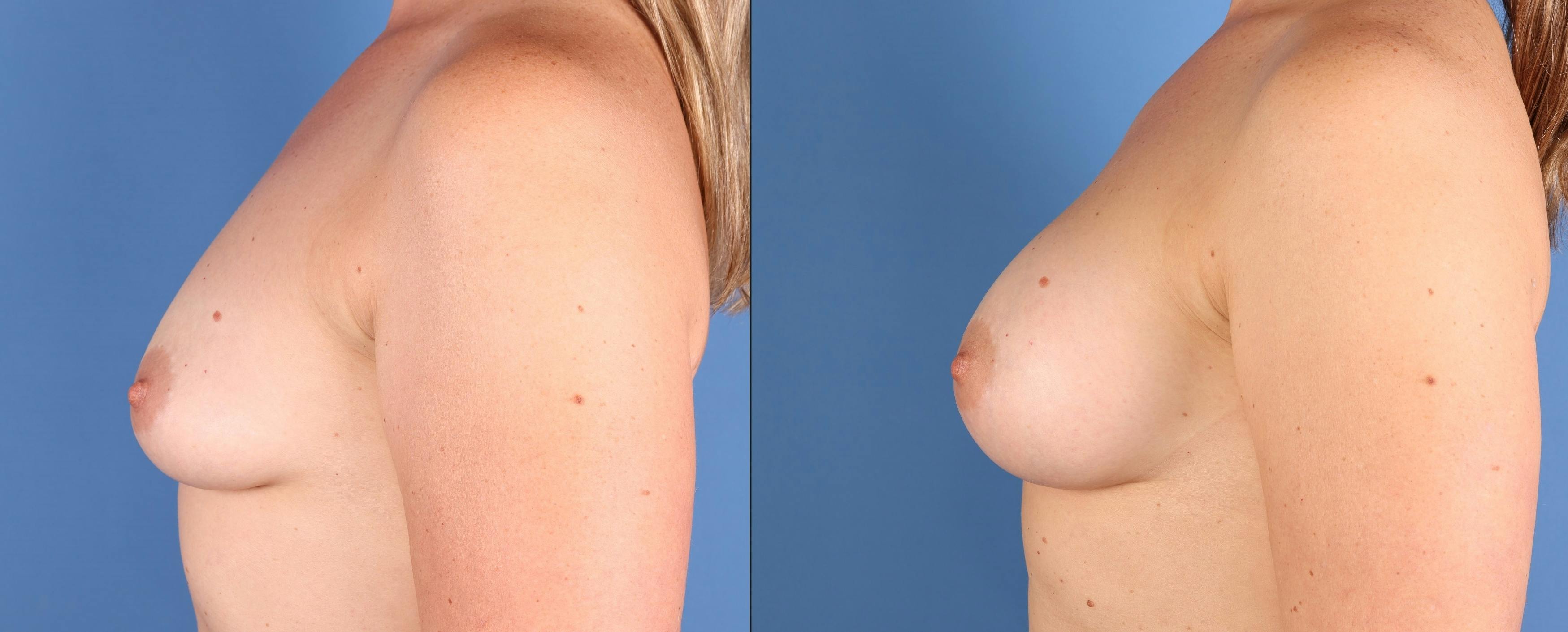 Breast Augmentation Before & After Gallery - Patient 163826 - Image 3