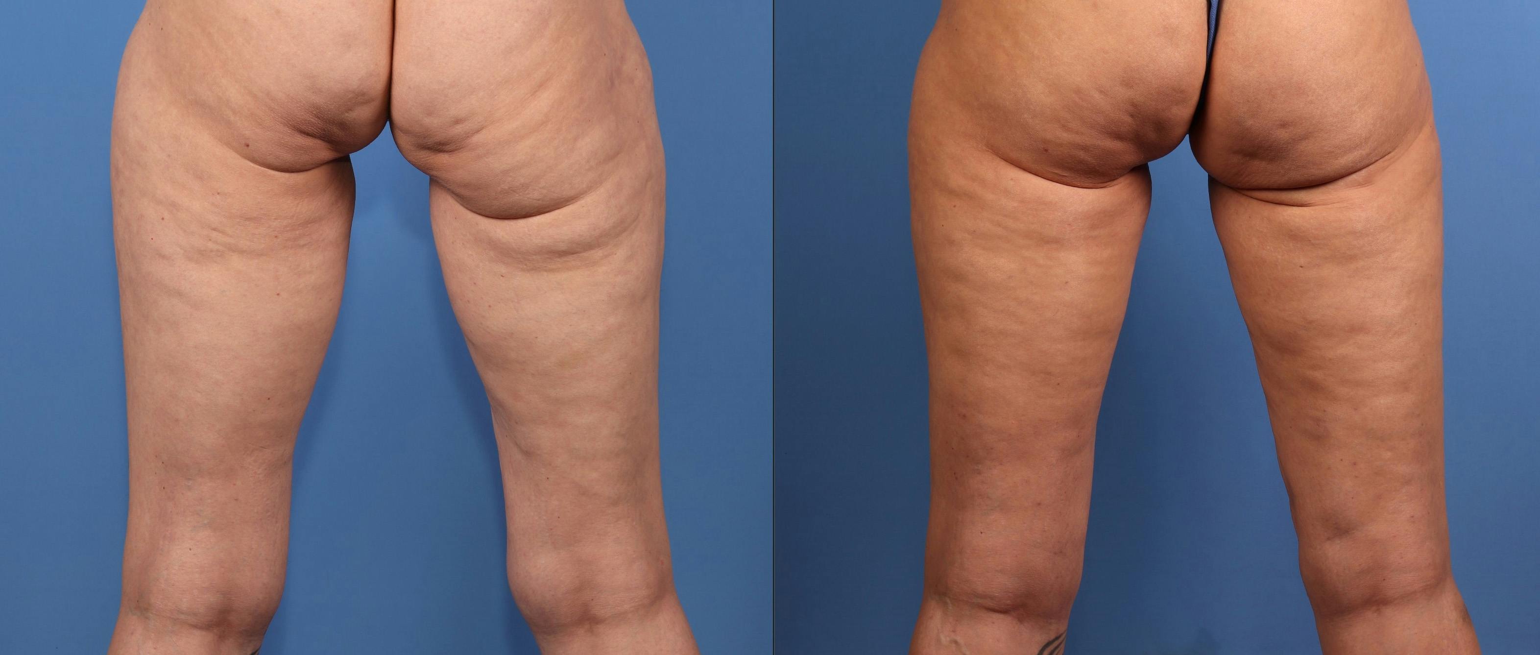 Buttocks Before & After Gallery - Patient 172148 - Image 1