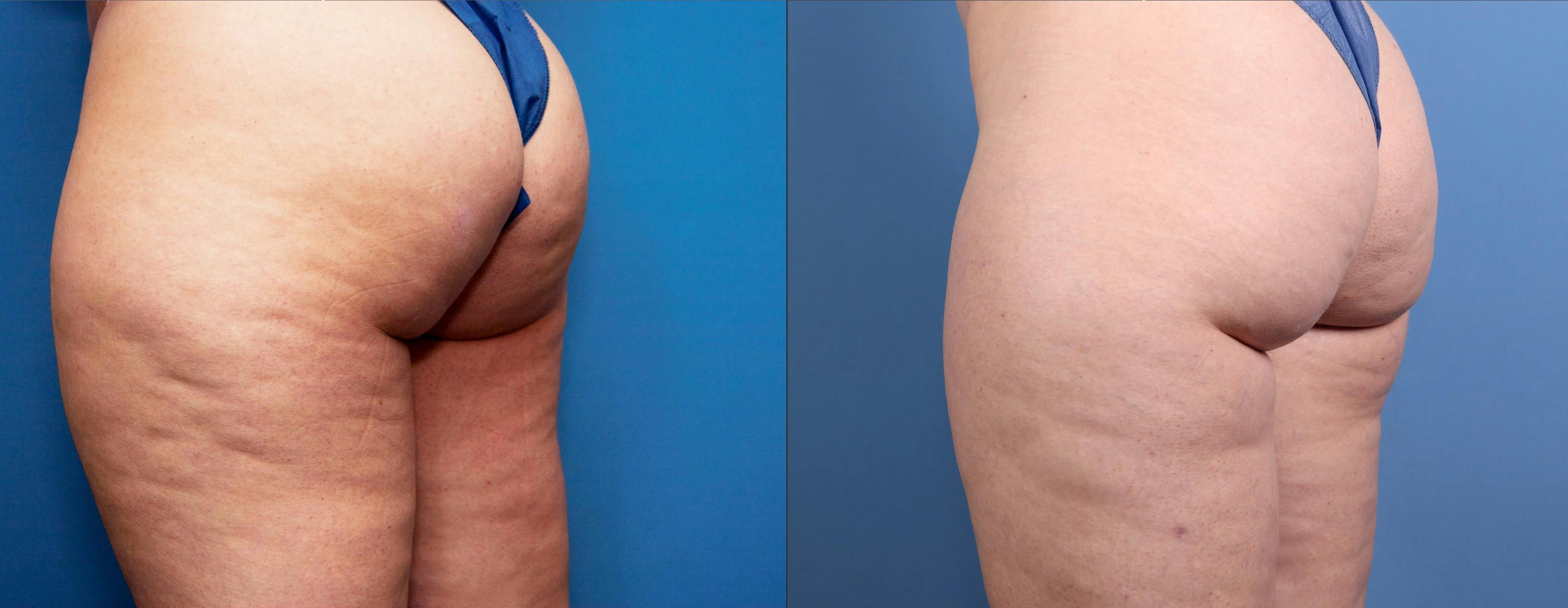 Aveli Before & After Gallery - Patient 149500 - Image 3