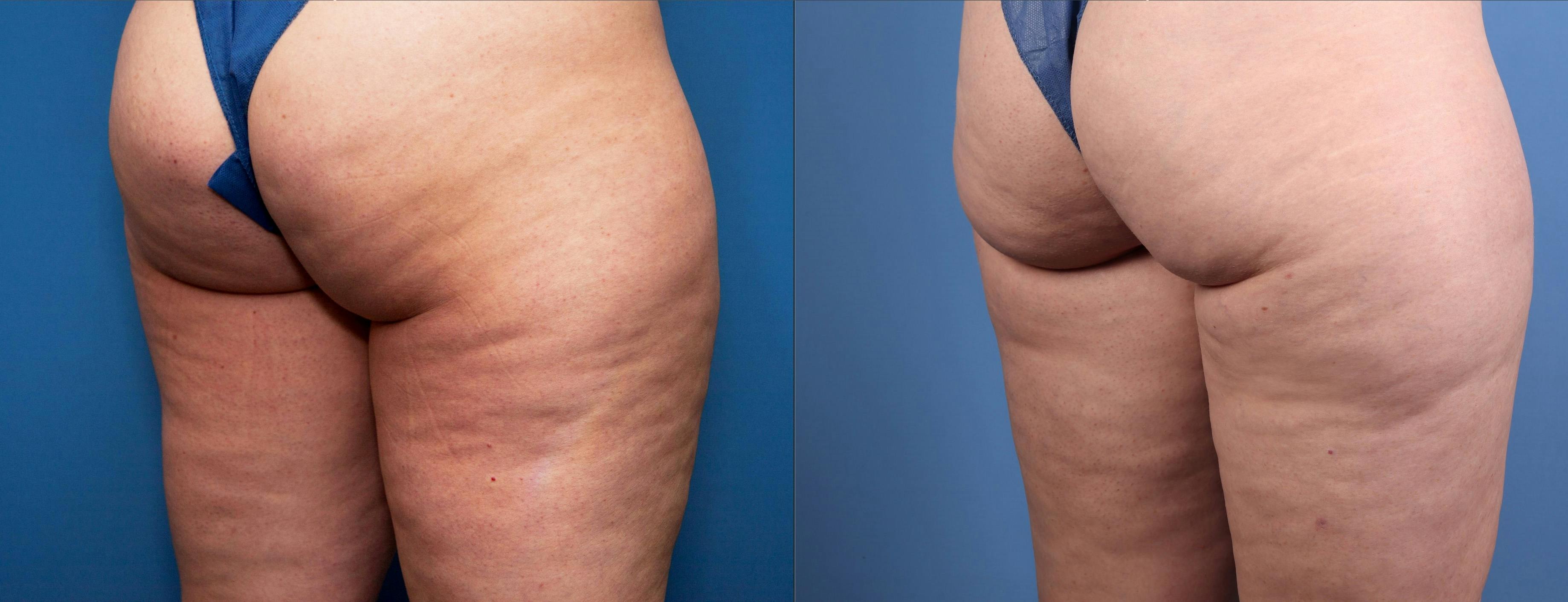 Aveli Before & After Gallery - Patient 149500 - Image 2