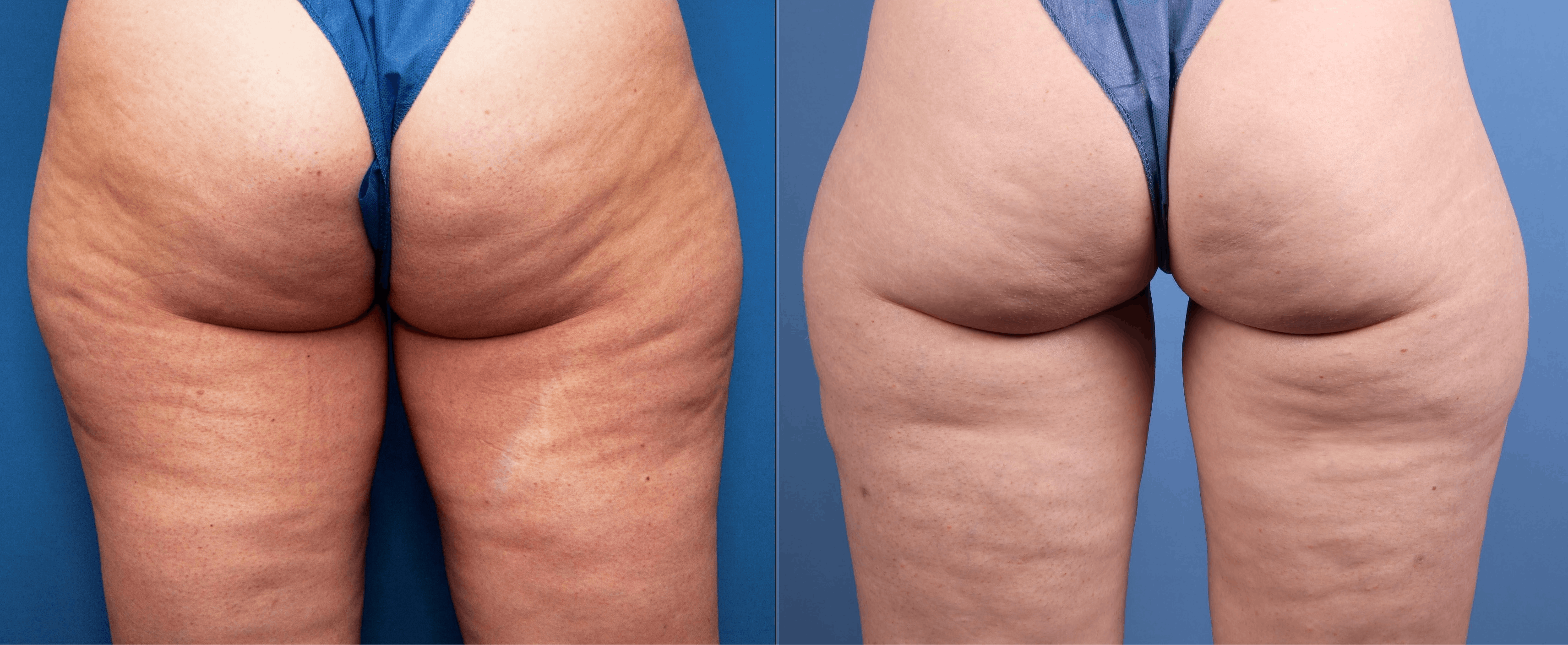 Aveli Before & After Gallery - Patient 149500 - Image 1