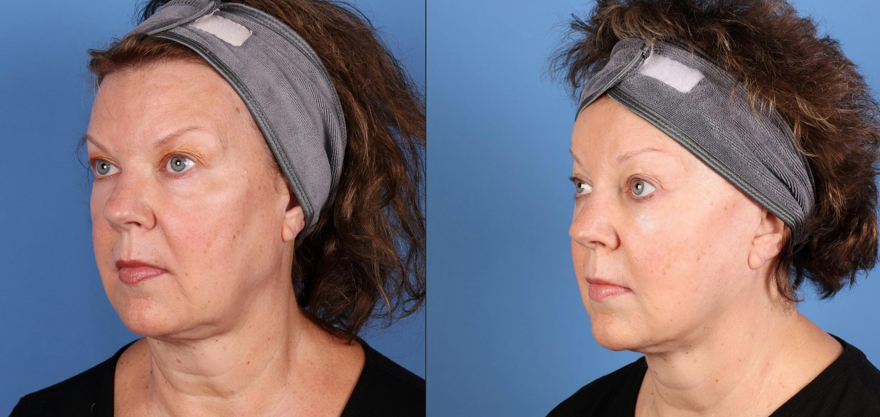 Laser Treatments Before & After Gallery - Patient 453710 - Image 4