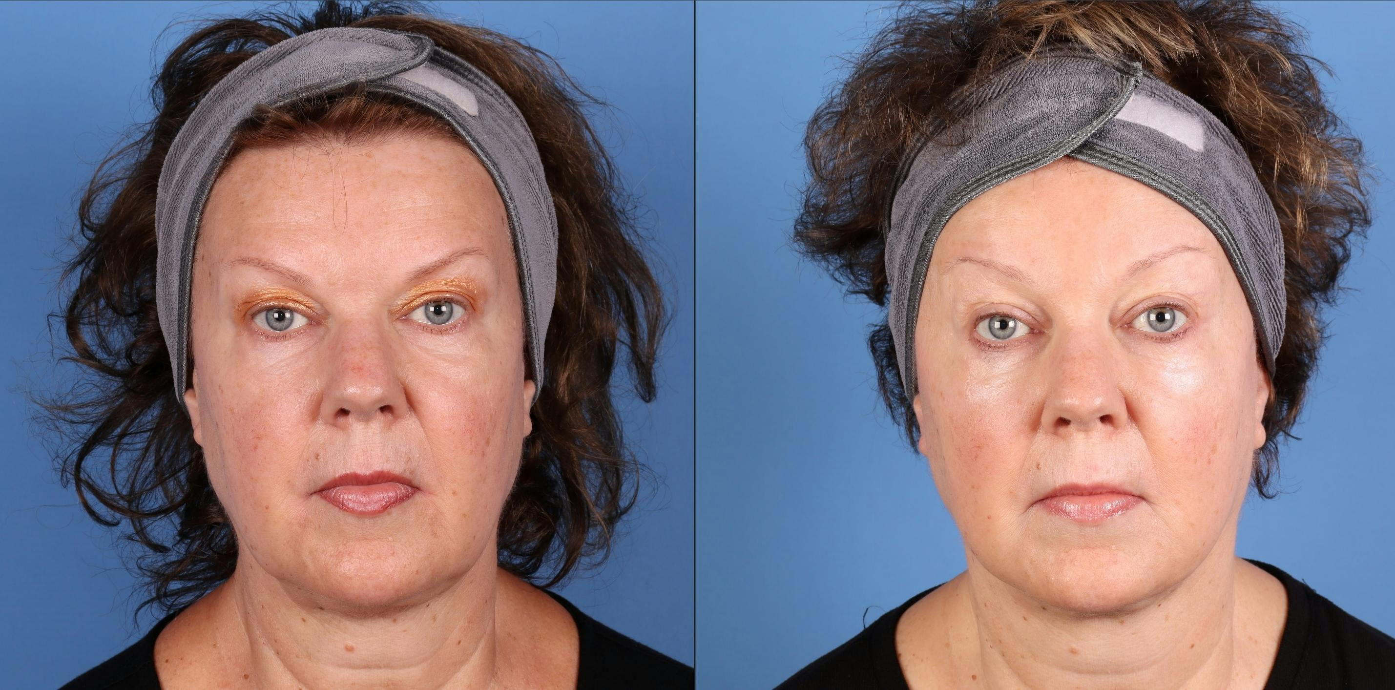 Laser Treatments Before & After Gallery - Patient 453710 - Image 1