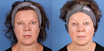 Eyelid Surgery (Upper Blepharoplasty) Before & After Gallery - Patient 231094 - Image 1