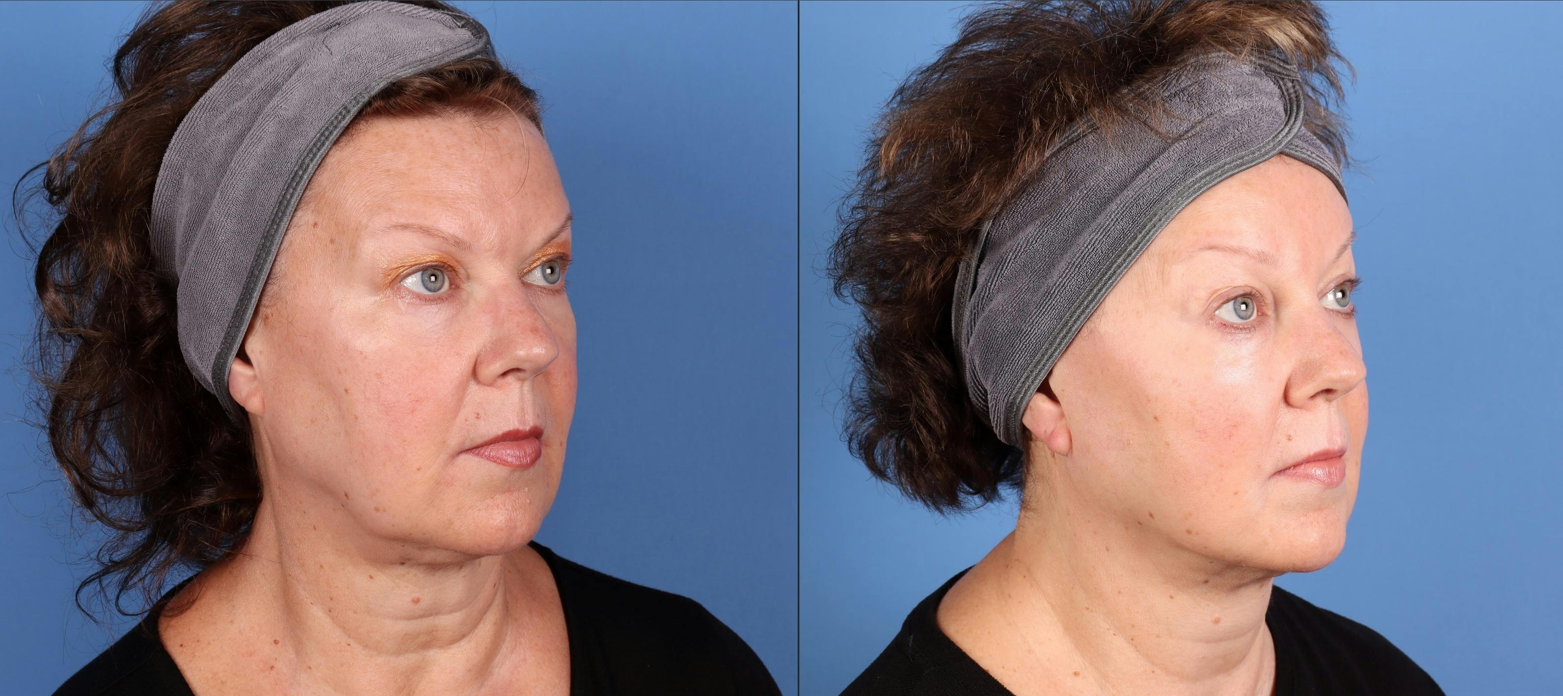 Laser Treatments Before & After Gallery - Patient 453710 - Image 3