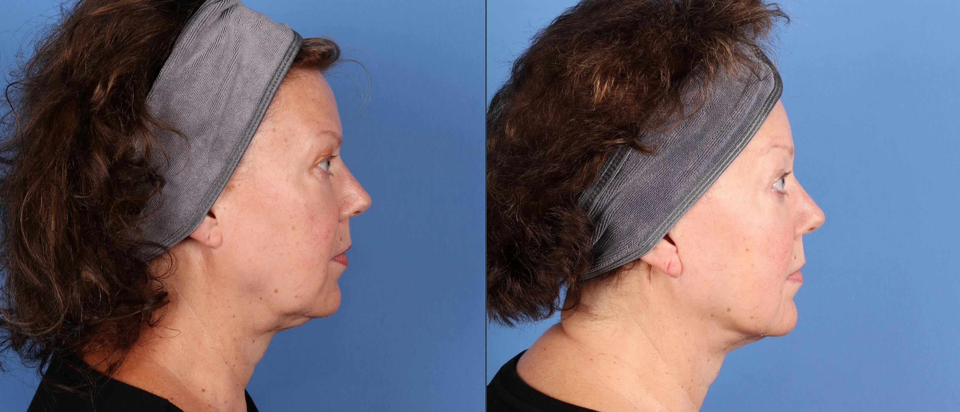 Laser Treatments Before & After Gallery - Patient 453710 - Image 2