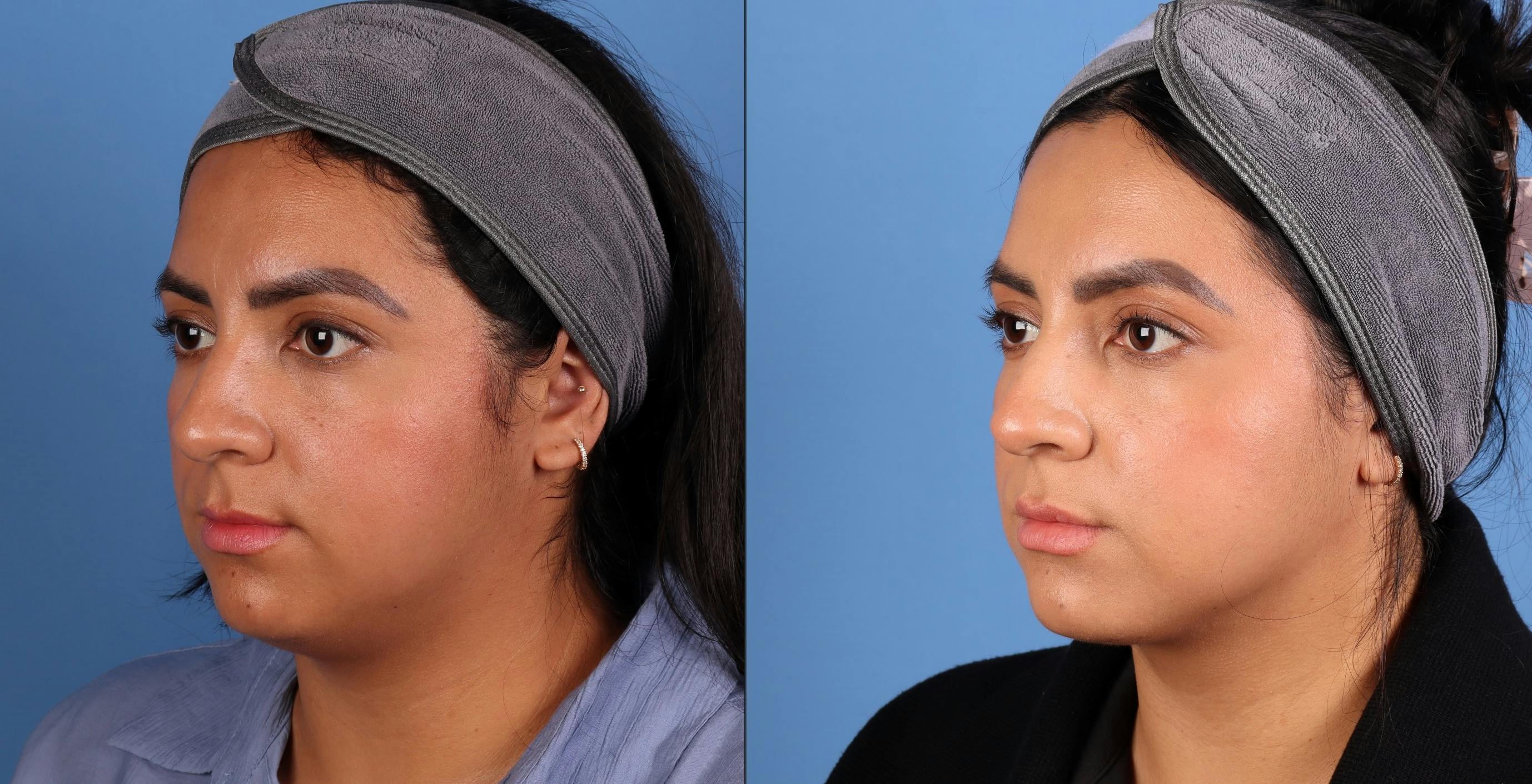 Face & Neck Before & After Gallery - Patient 231552 - Image 2