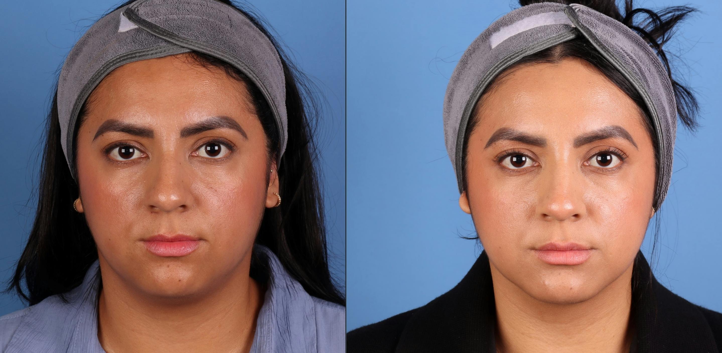 Face & Neck Before & After Gallery - Patient 231552 - Image 1