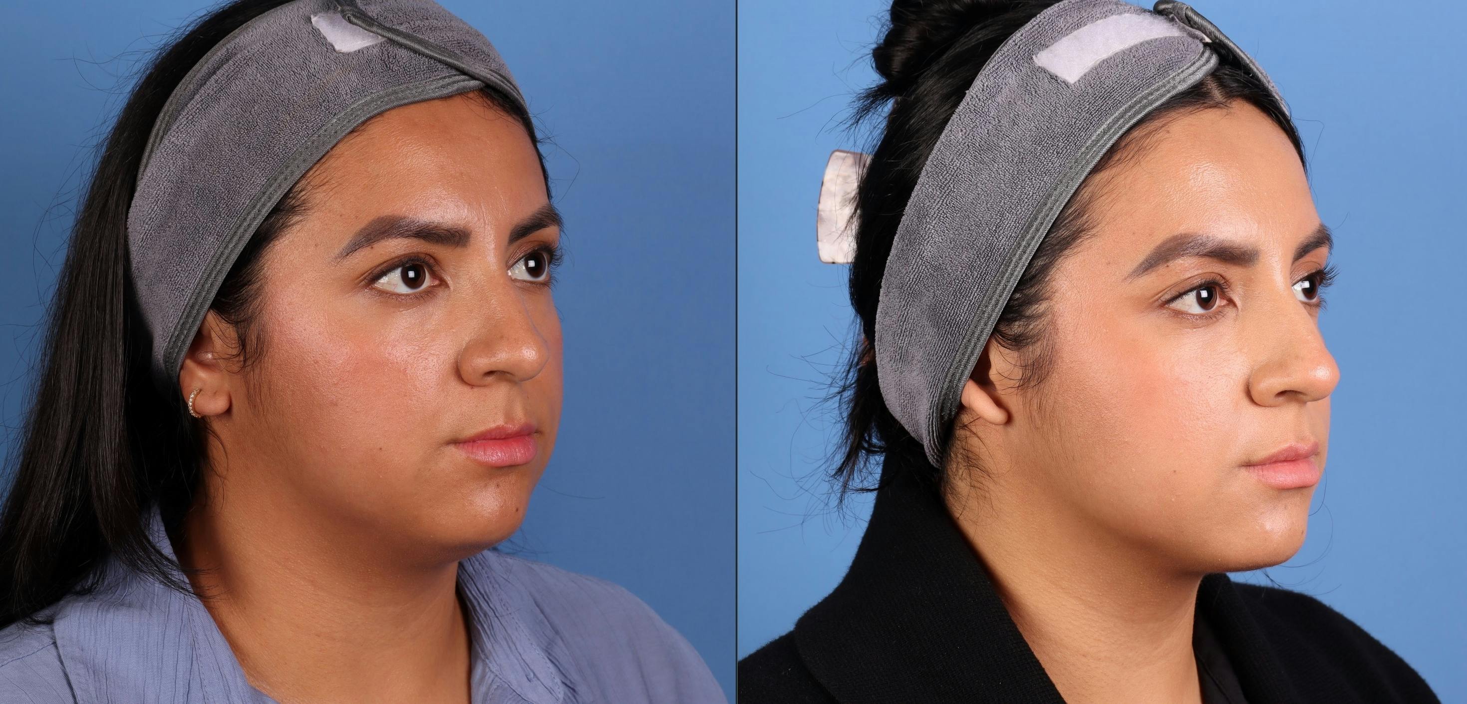 Face & Neck Before & After Gallery - Patient 231552 - Image 5