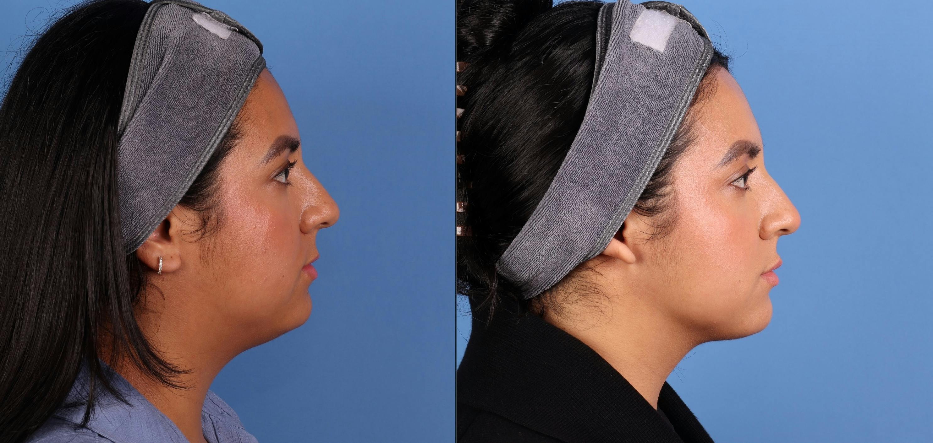 Face & Neck Before & After Gallery - Patient 231552 - Image 4