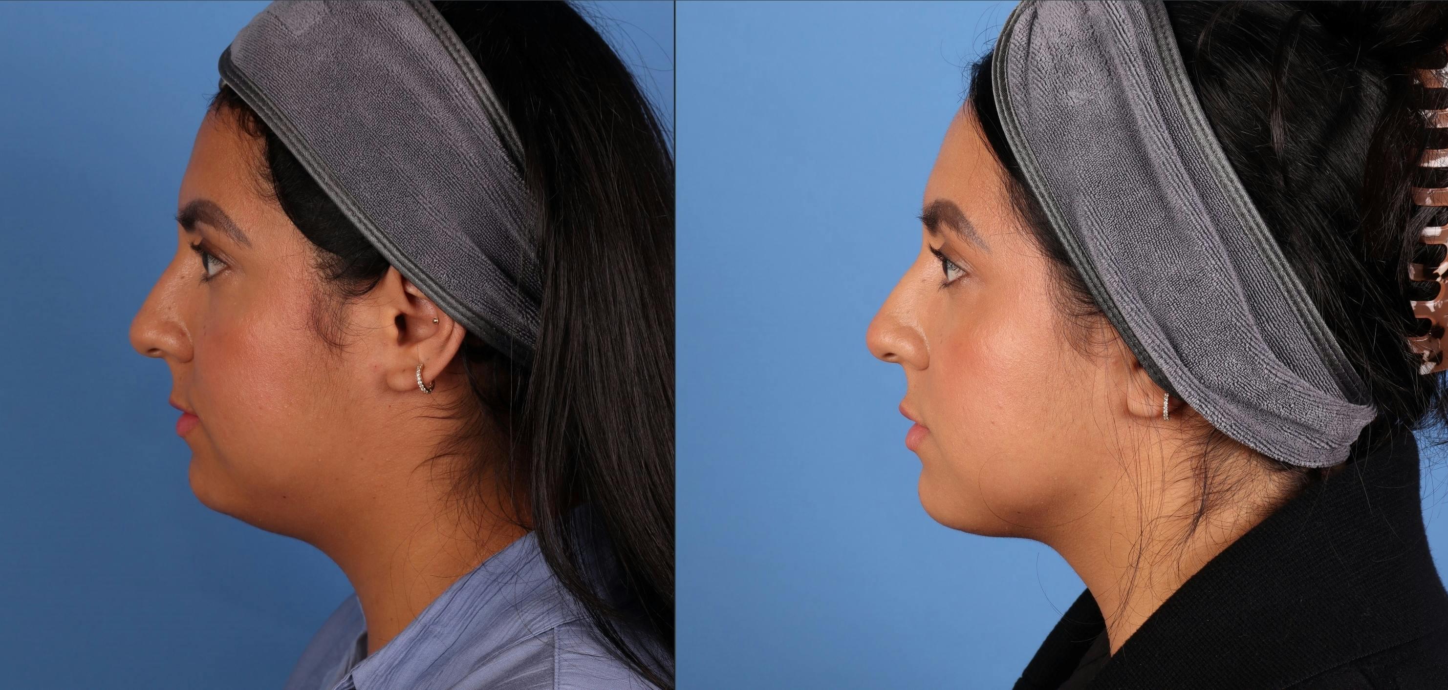 Face & Neck Before & After Gallery - Patient 231552 - Image 3