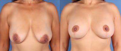 Breast Lift Before & After Gallery - Patient 553418 - Image 1