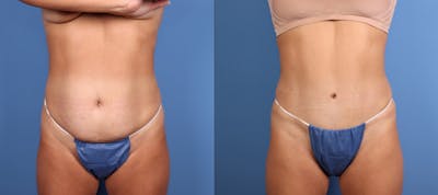 Tummy Tuck Before & After Gallery - Patient 237669 - Image 1