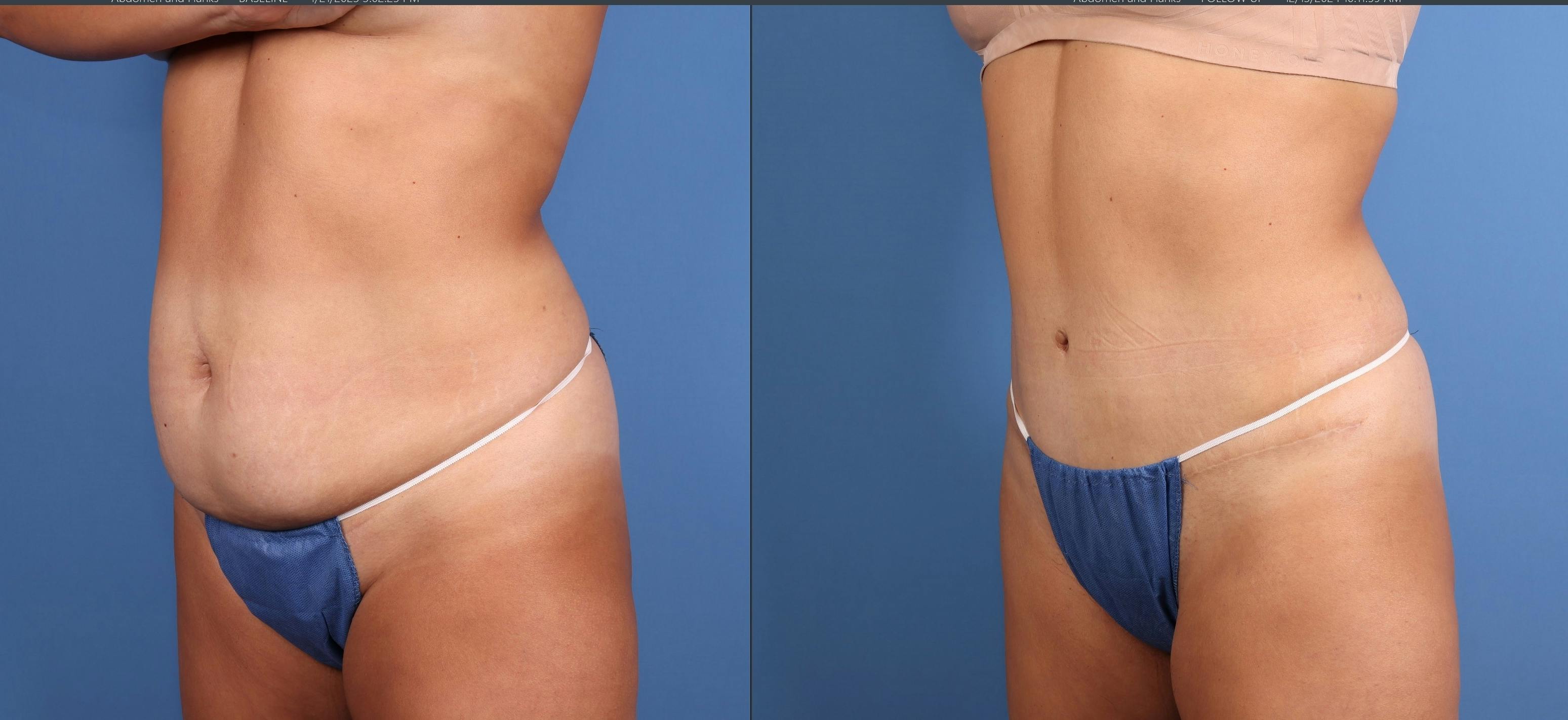 Tummy Tuck Before & After Gallery - Patient 237669 - Image 2