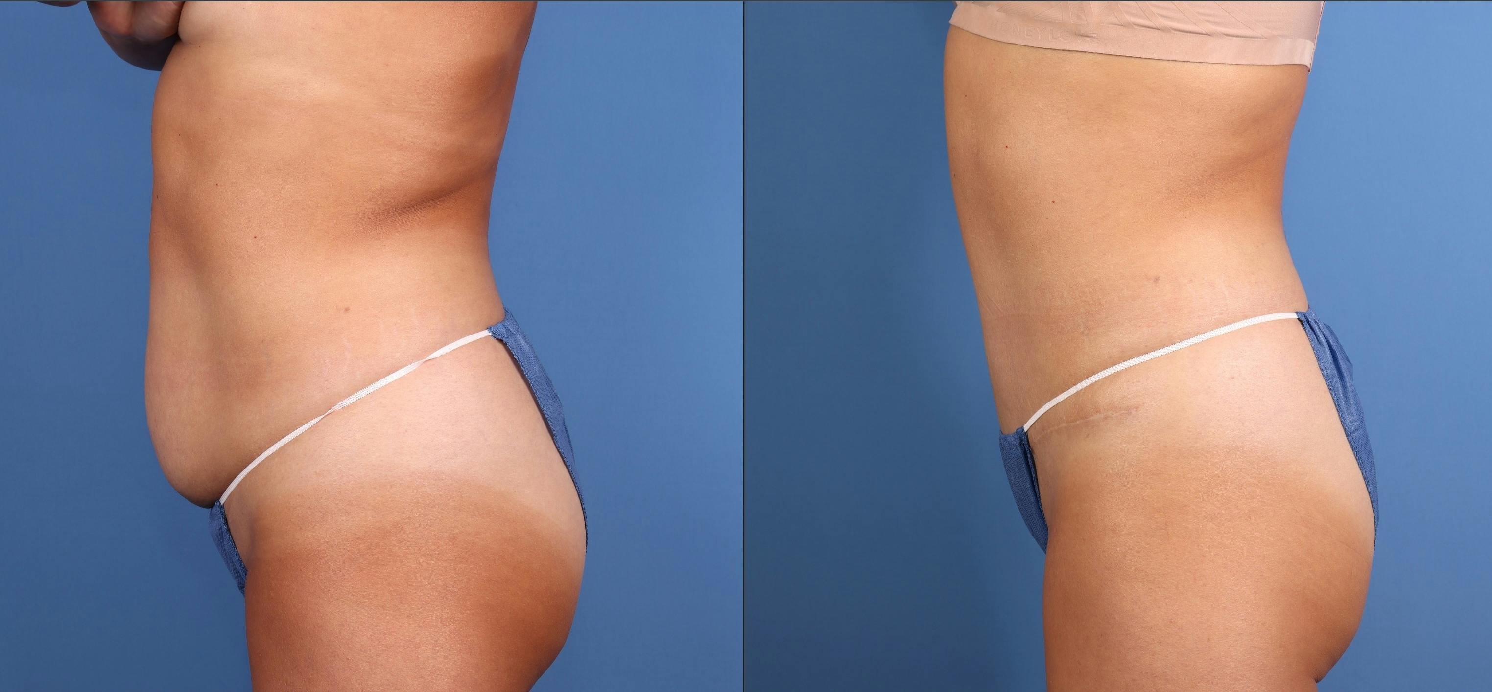 Tummy Tuck Before & After Gallery - Patient 237669 - Image 3