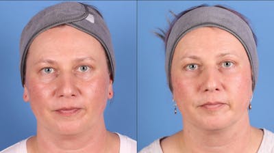 Eyelid Surgery (Upper & Lower Blepharoplasty) Before & After Gallery - Patient 121156 - Image 1