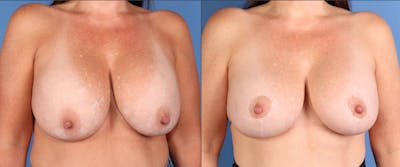 Breast Lift Before & After Gallery - Patient 154289 - Image 1