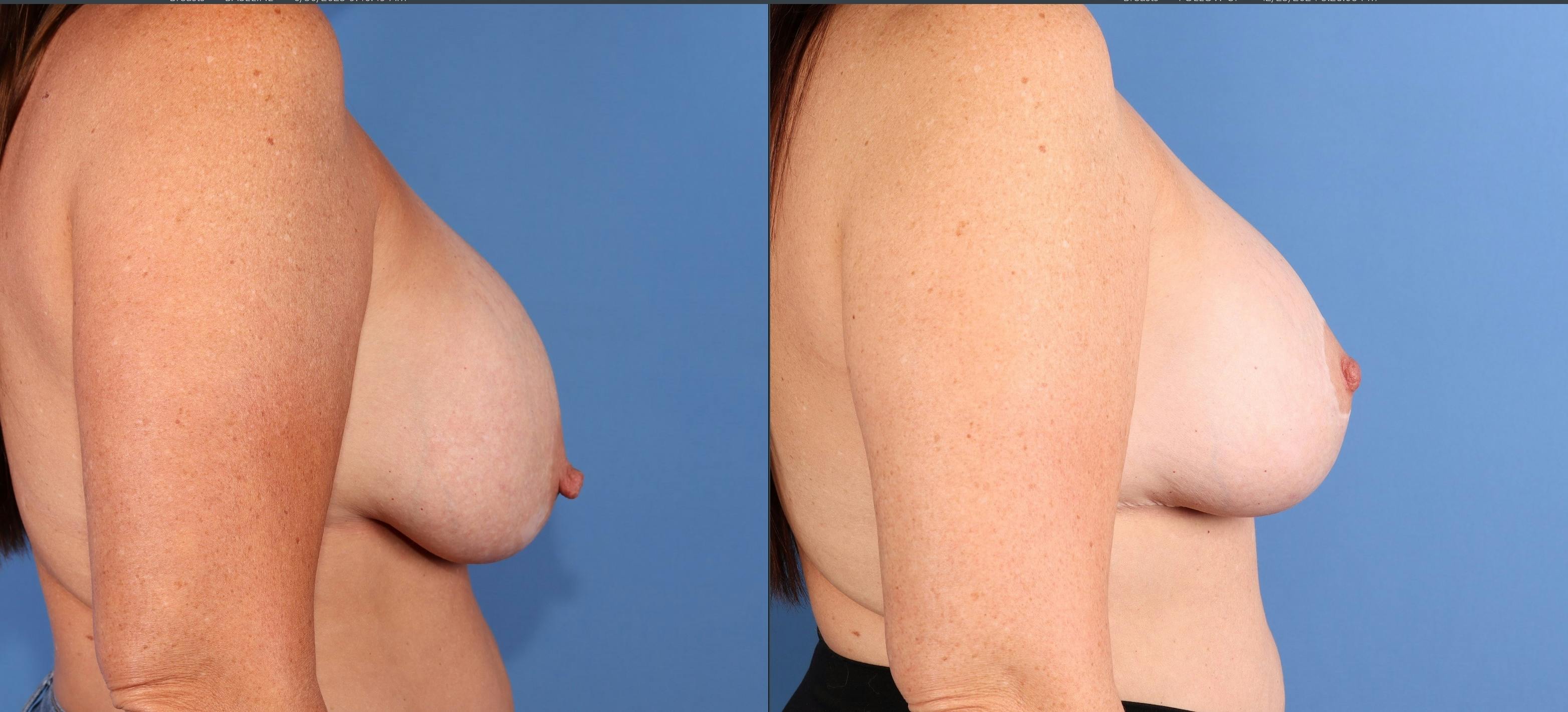 Breast Lift Before & After Gallery - Patient 154289 - Image 3