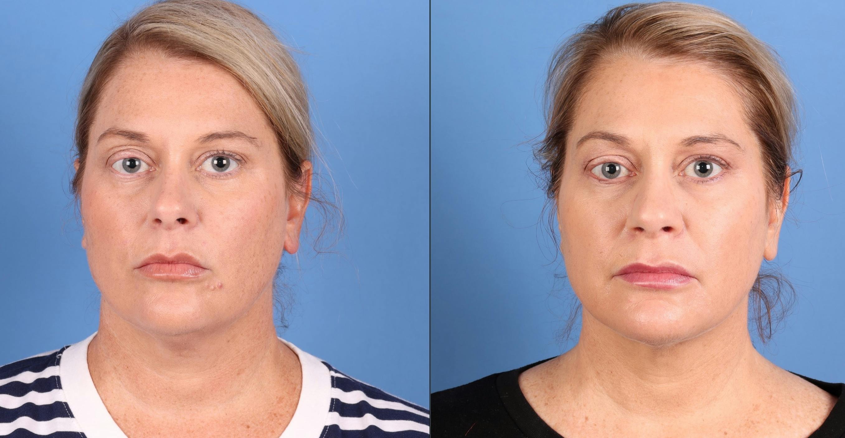 Face & Neck Before & After Gallery - Patient 197789 - Image 3