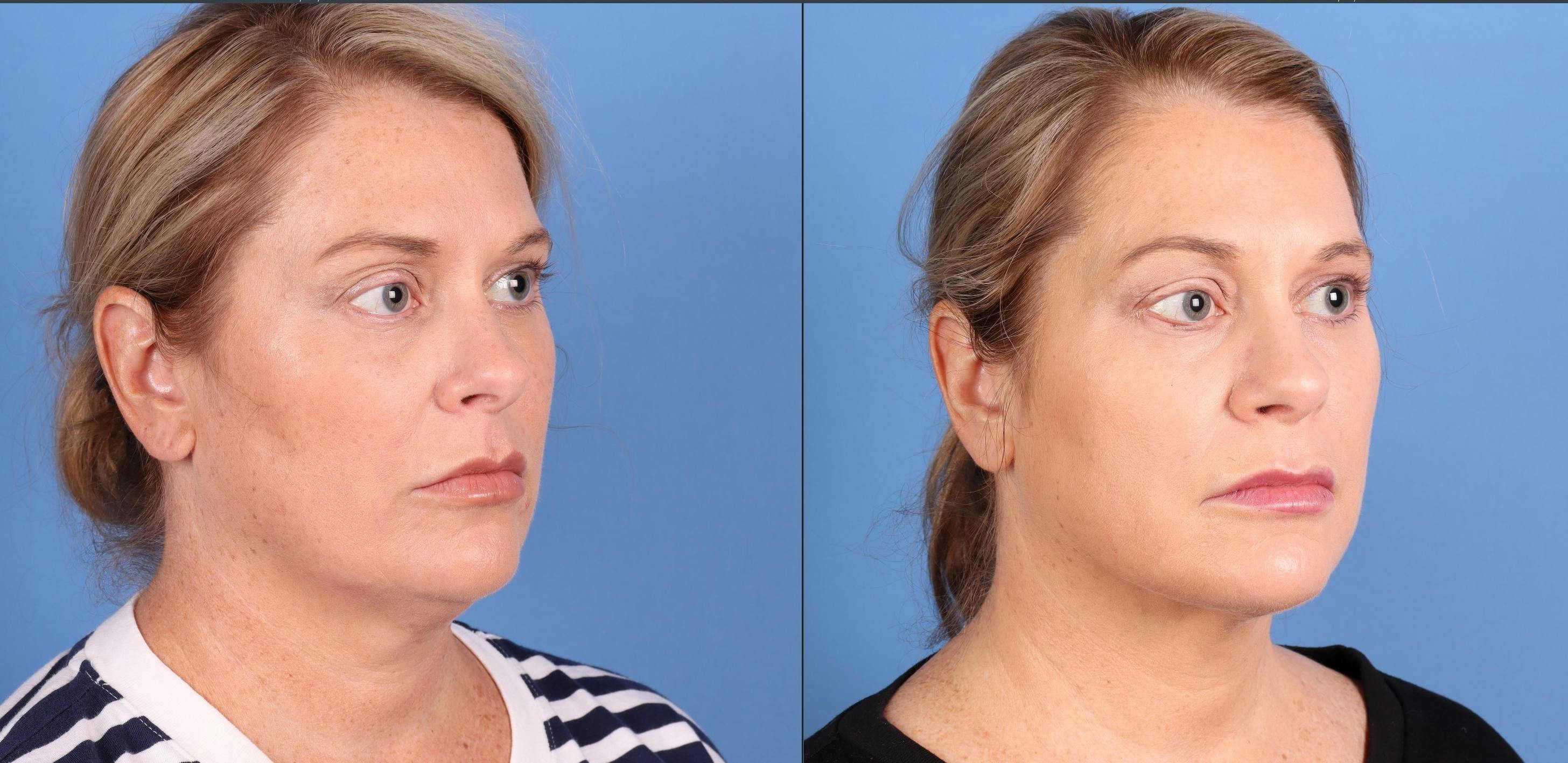 Face & Neck Before & After Gallery - Patient 197789 - Image 2