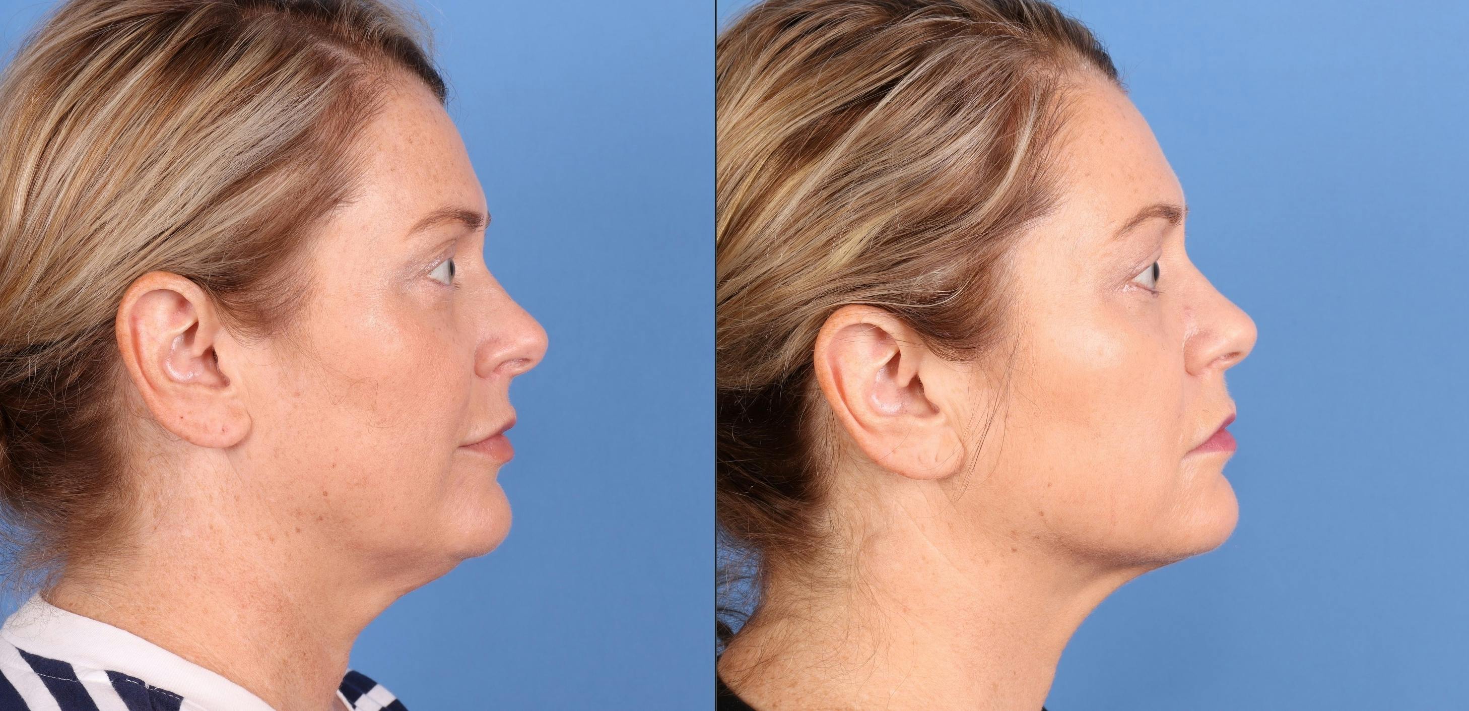 Face & Neck Before & After Gallery - Patient 197789 - Image 1