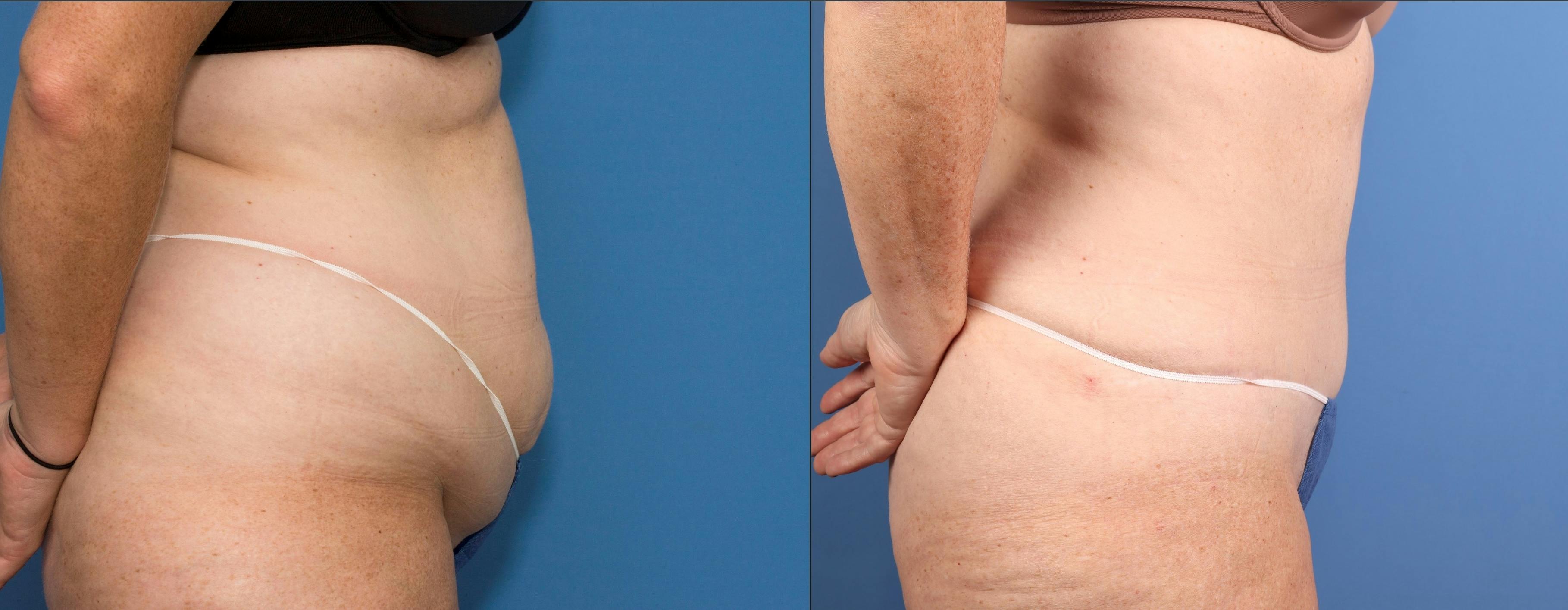 Face & Neck Before & After Gallery - Patient 197789 - Image 6
