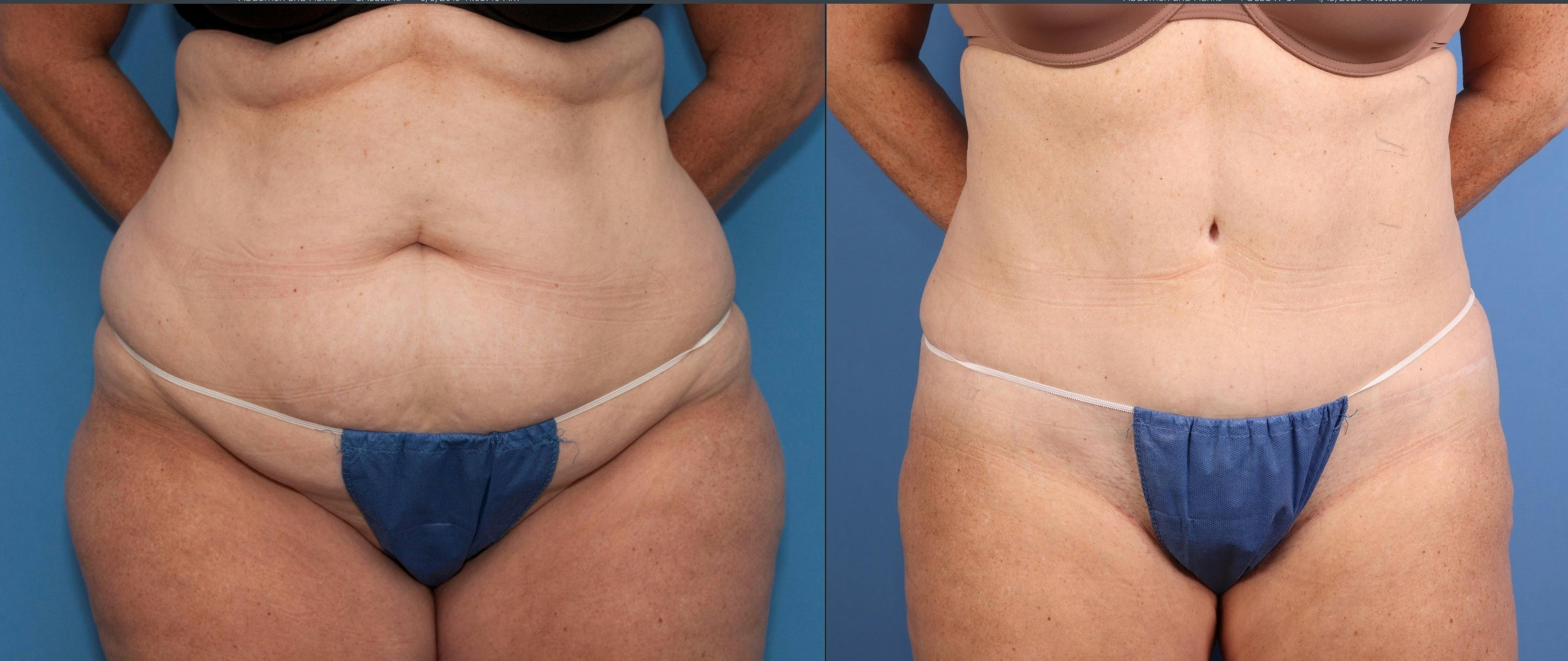 Abdomen Before & After Gallery - Patient 242535 - Image 1
