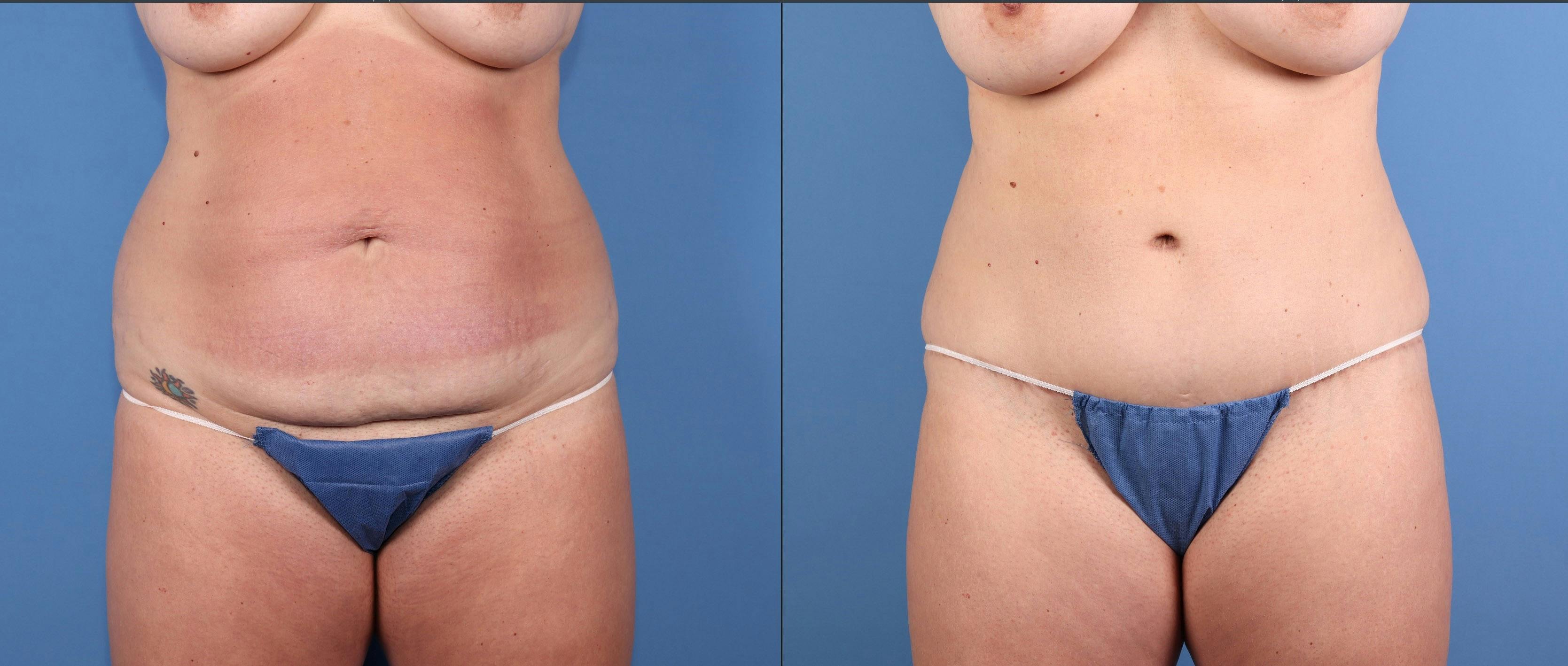Mommy Makeover Before & After Gallery - Patient 187486 - Image 2