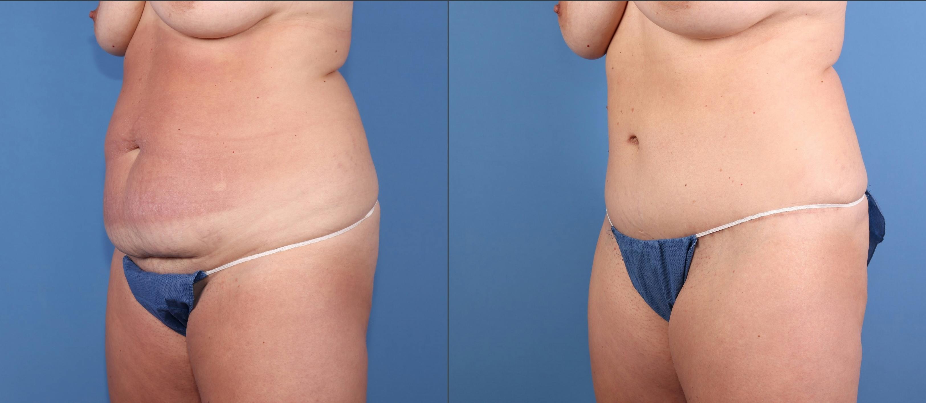 Mommy Makeover Before & After Gallery - Patient 187486 - Image 4