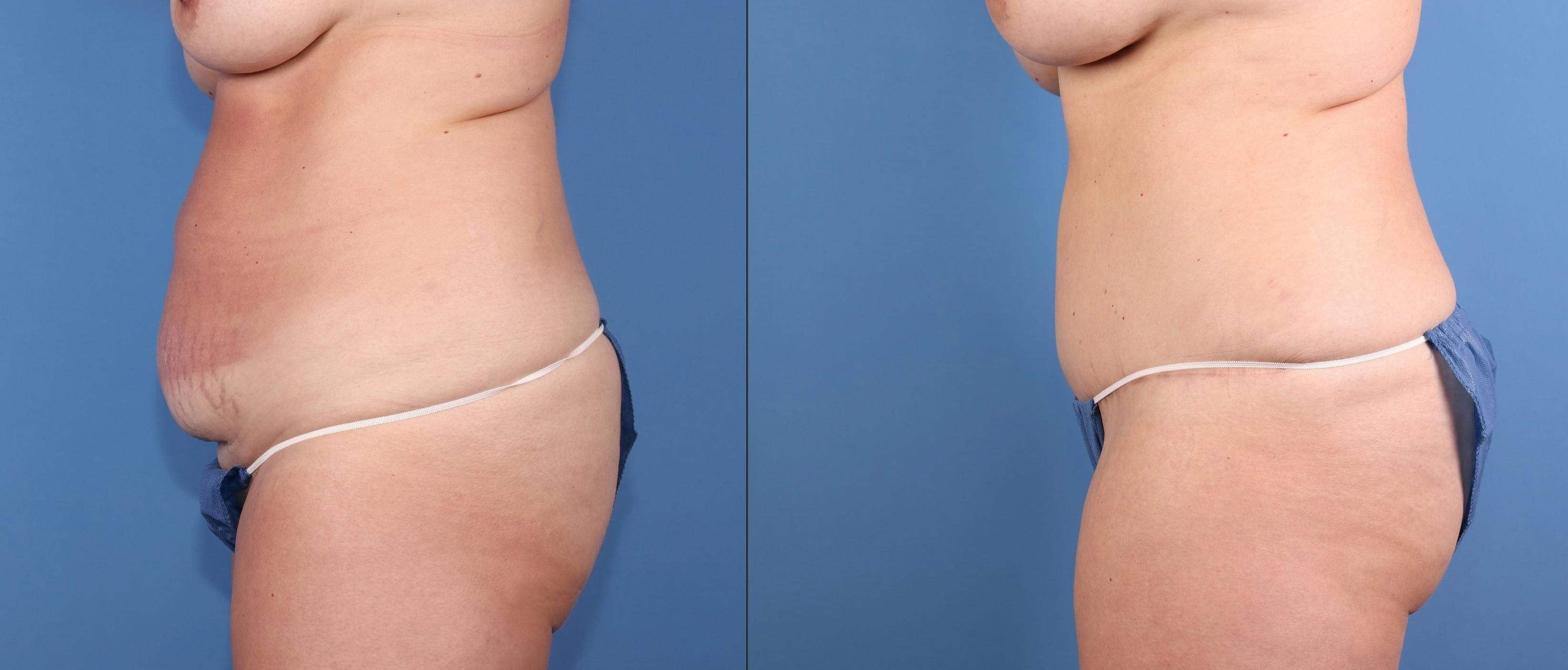 Mommy Makeover Before & After Gallery - Patient 187486 - Image 3