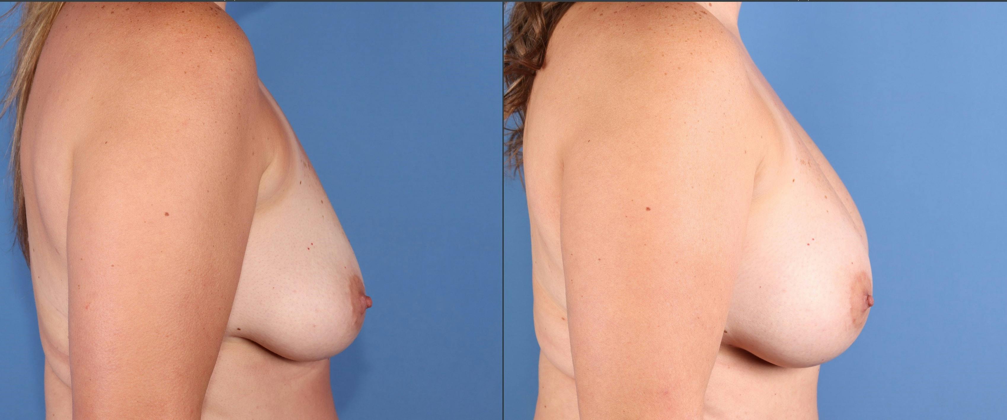 Mommy Makeover Before & After Gallery - Patient 187486 - Image 5