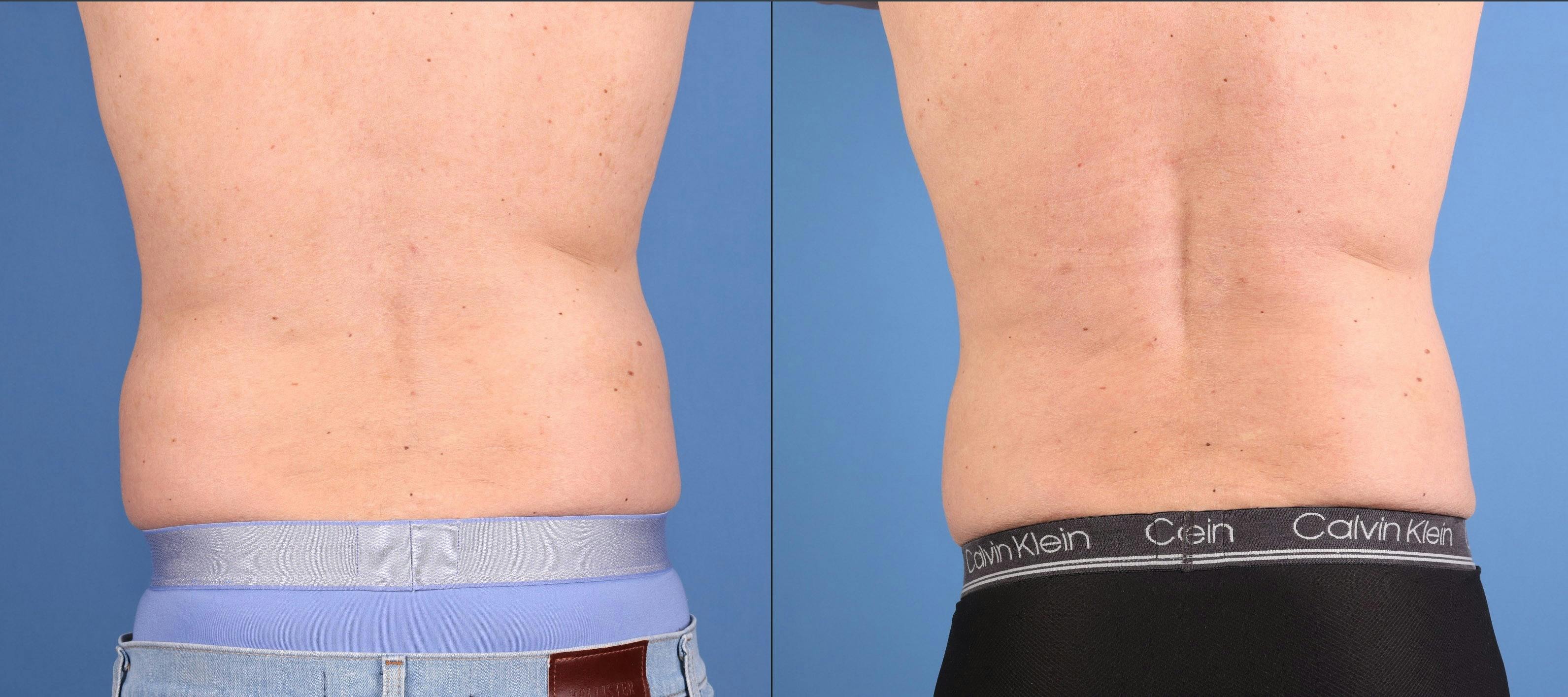Abdomen Before & After Gallery - Patient 260016 - Image 5