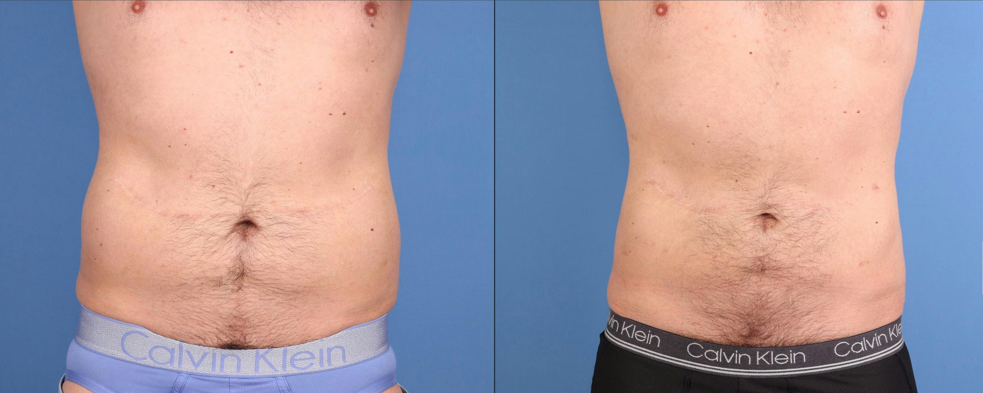 Abdomen Before & After Gallery - Patient 260016 - Image 1