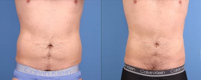 Abdomen Before & After Gallery - Patient 260016 - Image 1