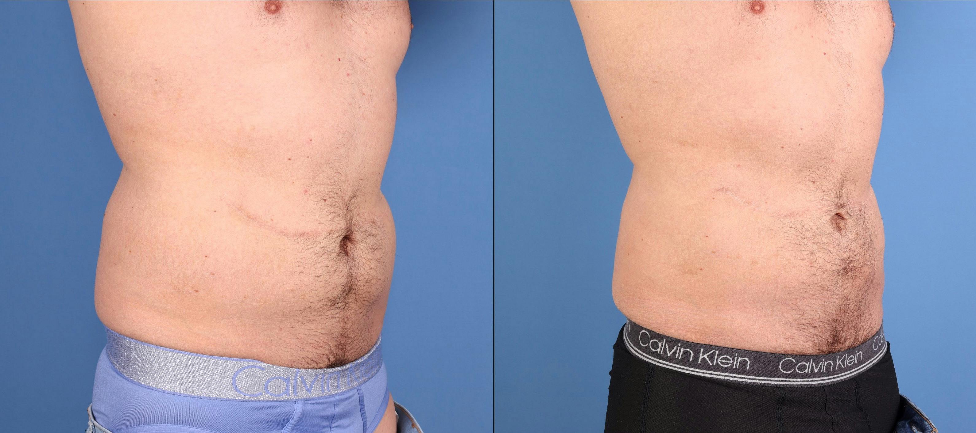 Abdomen Before & After Gallery - Patient 260016 - Image 2