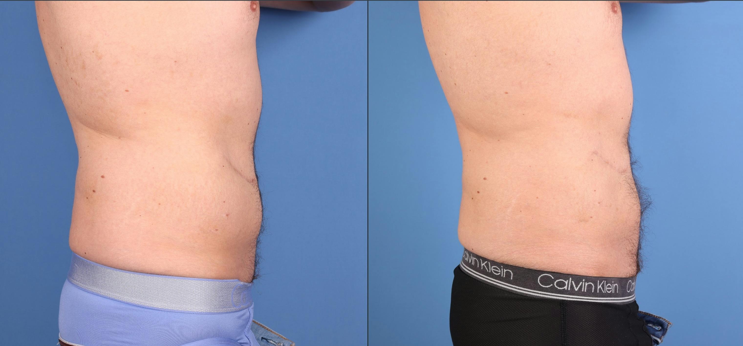 Abdomen Before & After Gallery - Patient 260016 - Image 3