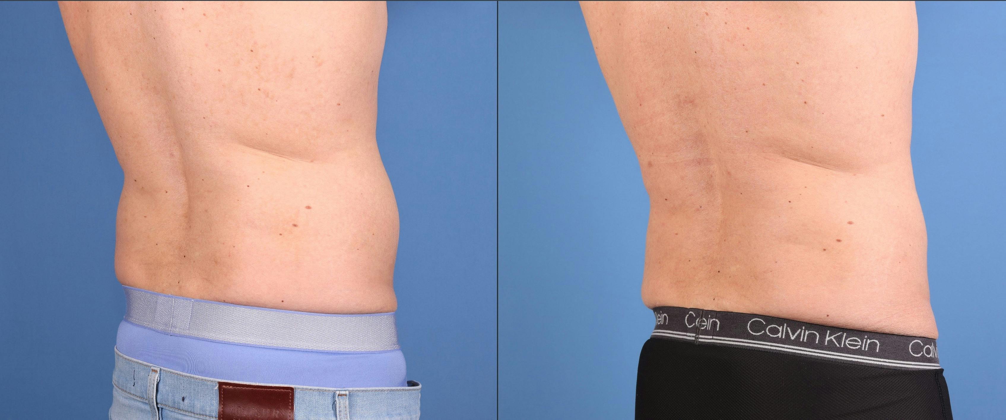 Abdomen Before & After Gallery - Patient 260016 - Image 4