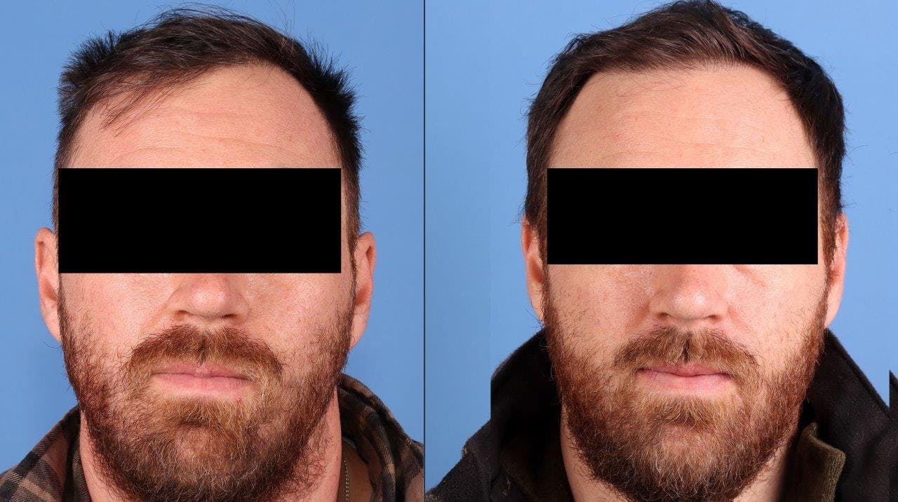 NeoGraft Hair Restoration Before & After Gallery - Patient 208817 - Image 1