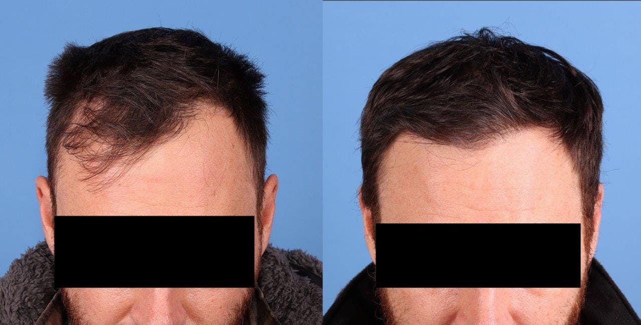 NeoGraft Hair Restoration Before & After Gallery - Patient 208817 - Image 4
