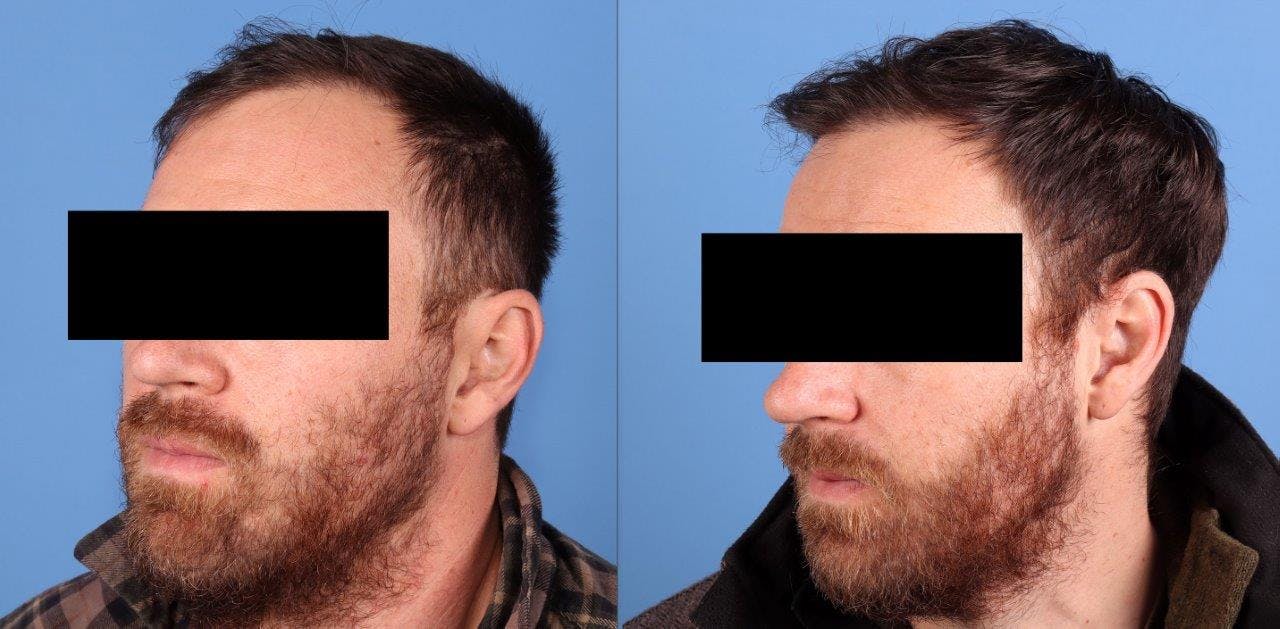 NeoGraft Hair Restoration Before & After Gallery - Patient 208817 - Image 3