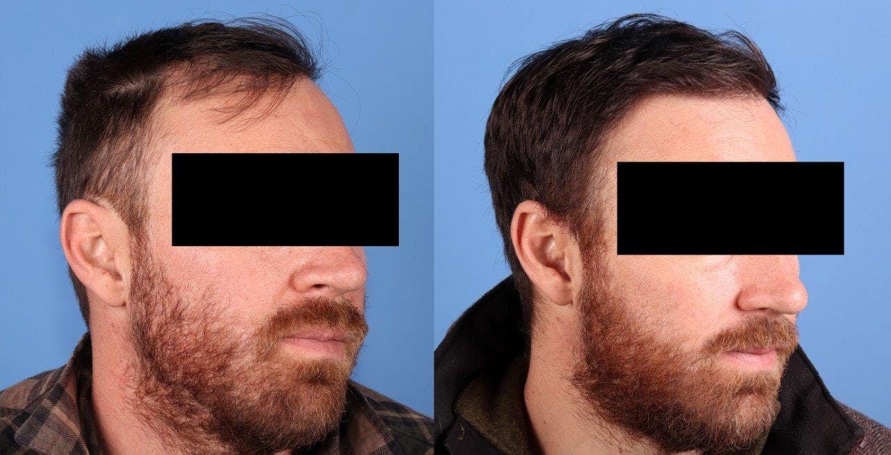 NeoGraft Hair Restoration Before & After Gallery - Patient 208817 - Image 2