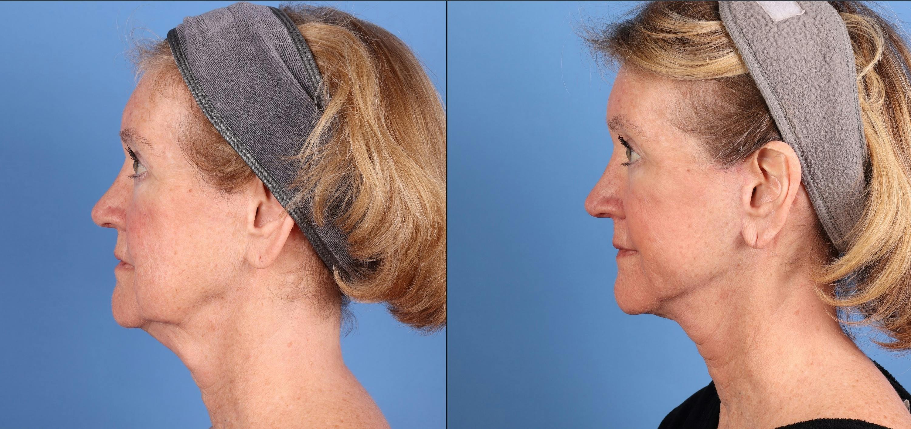Mini Facelift Before & After Gallery - Patient 362980 - Image 5
