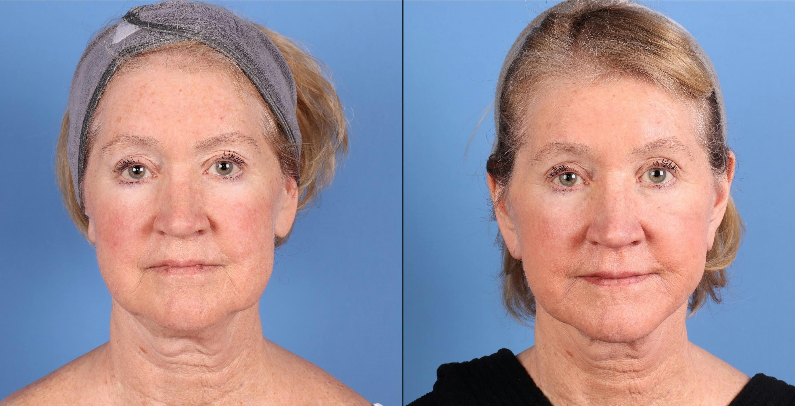 Mini Facelift Before & After Gallery - Patient 362980 - Image 1